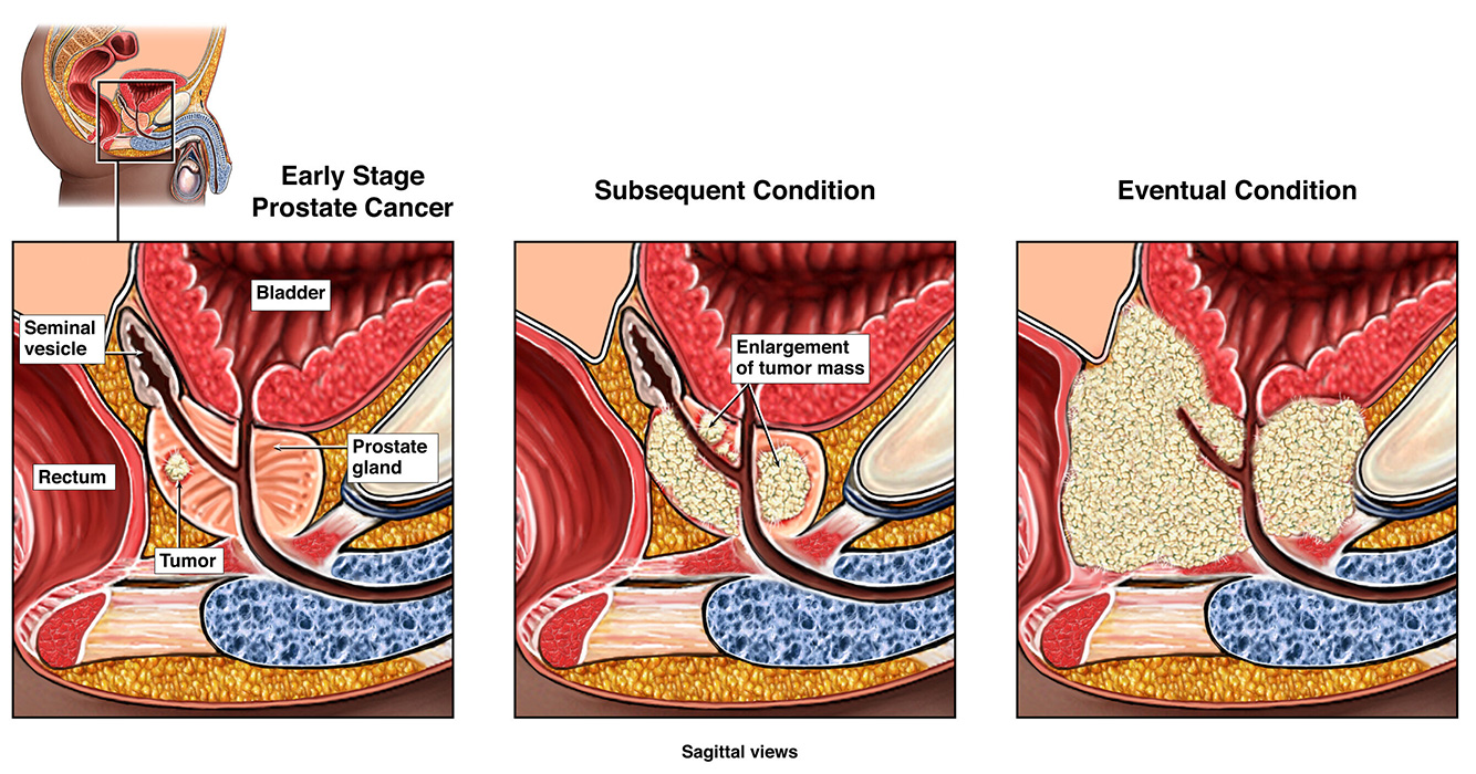 The three stages of prostate cancer development