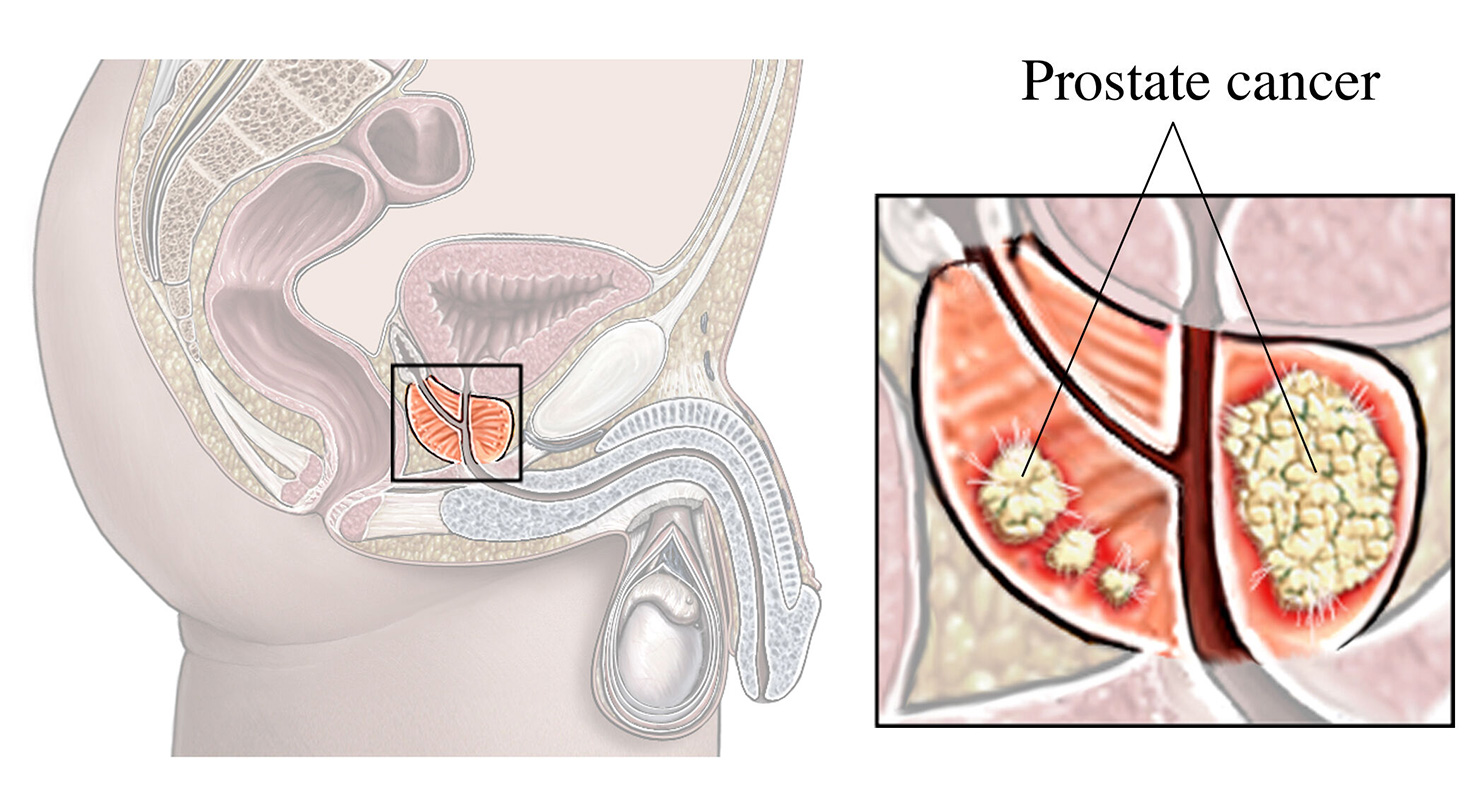 A cross section showing a prostate cancer tumor