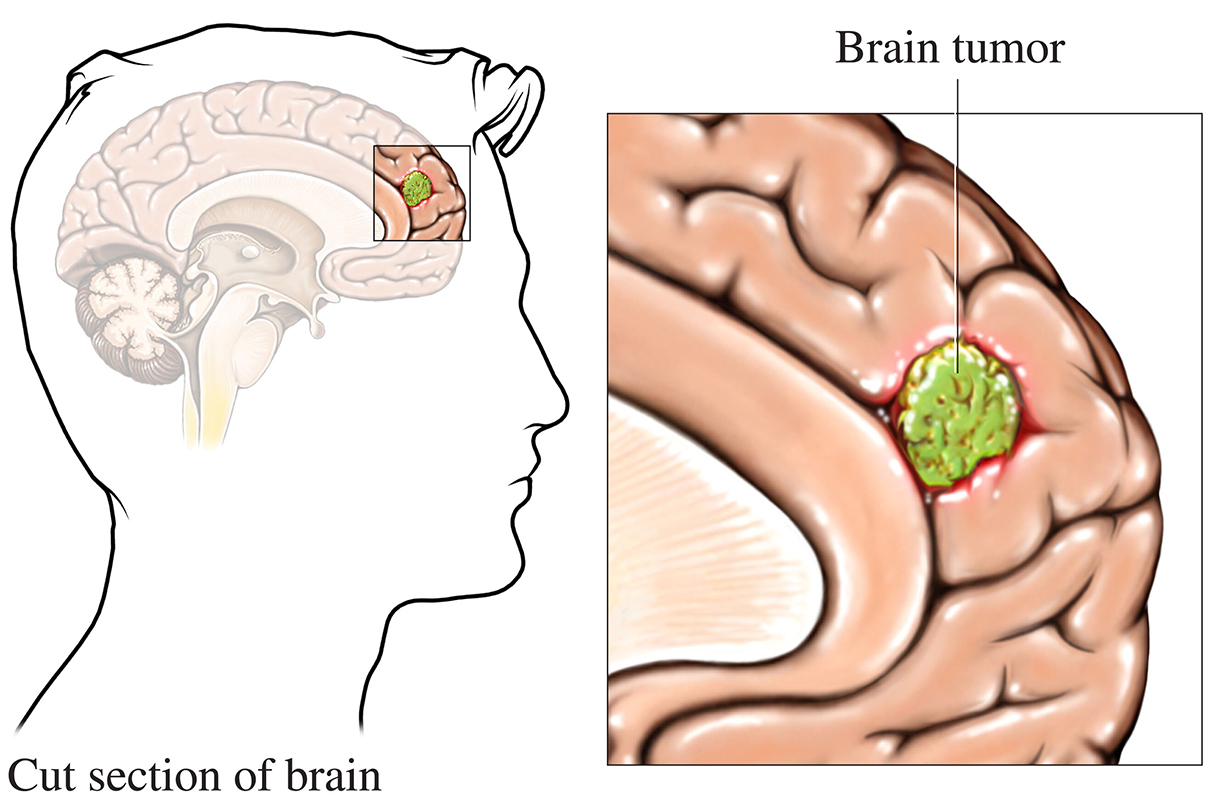 Brain Tumor Symptoms And Causes City Of Hope California